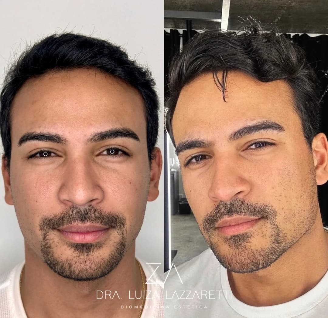 Imagem editorial sobre harmonização facial masculina com naturalidade